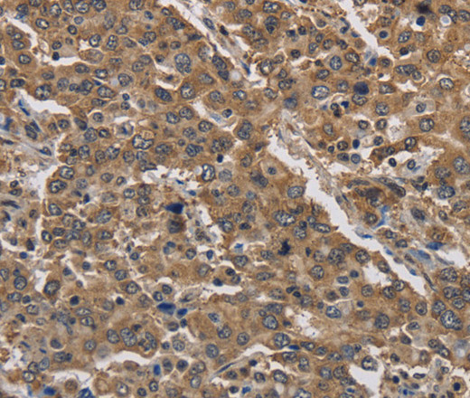 Immunohistochemistry of paraffin-embedded Human liver cancer tissue using JAG2 Polyclonal Antibody at dilution 1:30