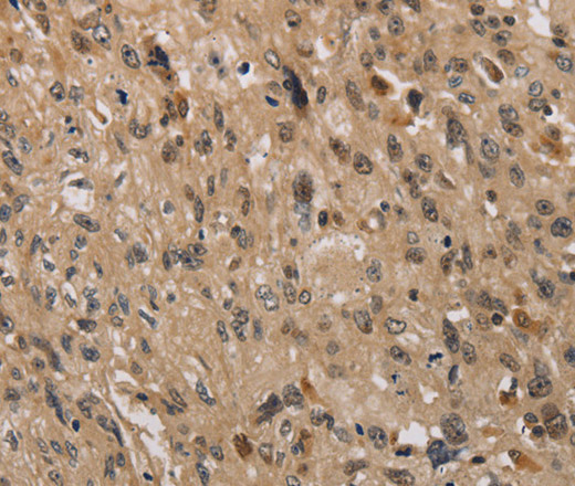 Immunohistochemistry of paraffin-embedded Human esophagus cancer using KDM4A Polyclonal Antibody at dilution of 1:40