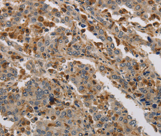 Immunohistochemistry of paraffin-embedded Human liver cancer using KDM4A Polyclonal Antibody at dilution of 1:40