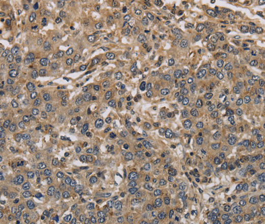 Immunohistochemistry of paraffin-embedded Human liver cancer using KCNA7 Polyclonal Antibody at dilution of 1:40