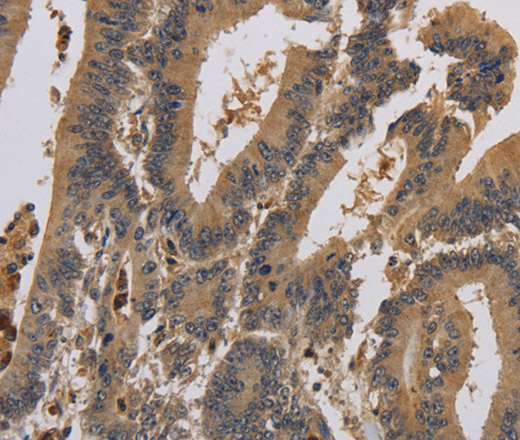 Immunohistochemistry of paraffin-embedded Human colon cancer using KCNA7 Polyclonal Antibody at dilution of 1:40