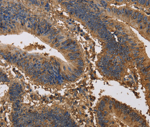 Immunohistochemistry of paraffin-embedded Human colon cancer tissue using KCNG1 Polyclonal Antibody at dilution 1:40