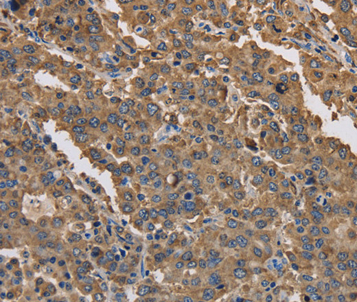 Immunohistochemistry of paraffin-embedded Human liver cancer tissue using KCNG1 Polyclonal Antibody at dilution 1:40