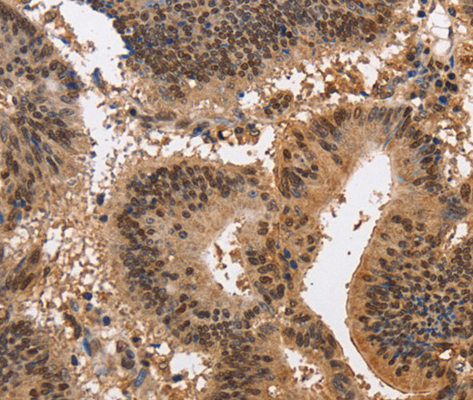 Immunohistochemistry of paraffin-embedded Human colon cancer using KCNG2 Polyclonal Antibody at dilution of 1:40