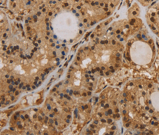 Immunohistochemistry of paraffin-embedded Human thyroid cancer tissue using KCNN4 Polyclonal Antibody at dilution 1:50