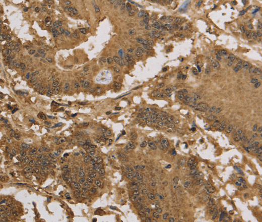 Immunohistochemistry of paraffin-embedded Human colon cancer tissue using KDM5B Polyclonal Antibody at dilution 1:40