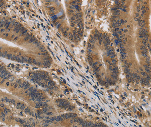 Immunohistochemistry of paraffin-embedded Human colon cancer tissue using KIF22 Polyclonal Antibody at dilution 1:40