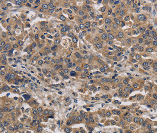 Immunohistochemistry of paraffin-embedded Human liver cancer tissue using KIF22 Polyclonal Antibody at dilution 1:40