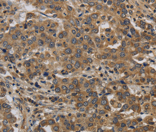 Immunohistochemistry of paraffin-embedded Human liver cancer tissue using KIF4A Polyclonal Antibody at dilution 1:40