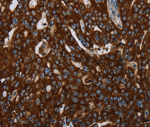 Immunohistochemistry of paraffin-embedded Human ovarian cancer tissue using KISS1R Polyclonal Antibody at dilution 1:30