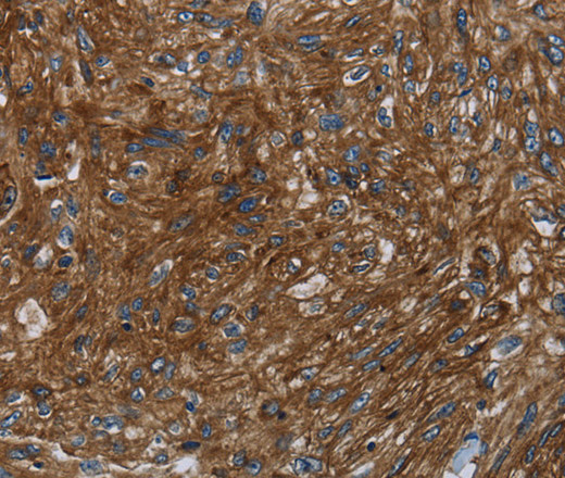 Immunohistochemistry of paraffin-embedded Human esophagus cancer tissue using KISS1R Polyclonal Antibody at dilution 1:30