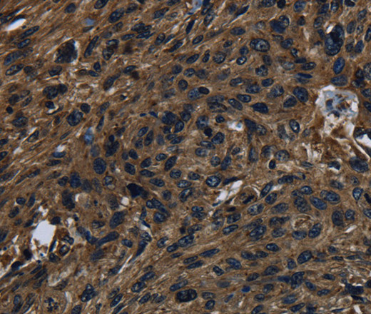 Immunohistochemistry of paraffin-embedded Human esophagus cancer using KLK14 Polyclonal Antibody at dilution of 1:40