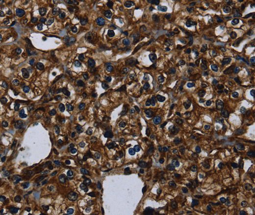 Immunohistochemistry of paraffin-embedded Human prostate cancer using KLK14 Polyclonal Antibody at dilution of 1:40