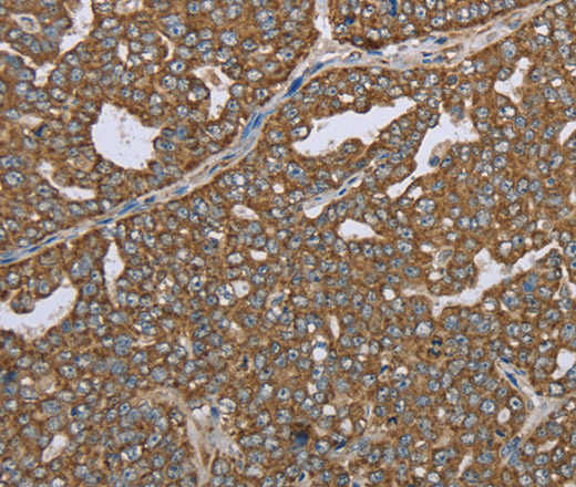 Immunohistochemistry of paraffin-embedded Human ovarian cancer using CERS4 Polyclonal Antibody at dilution of 1:35