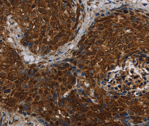 Immunohistochemistry of paraffin-embedded Human cervical cancer tissue using CERS5 Polyclonal Antibody at dilution 1:40