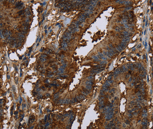 Immunohistochemistry of paraffin-embedded Human colon cancer tissue using CERS5 Polyclonal Antibody at dilution 1:40