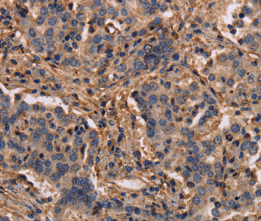 Immunohistochemistry of paraffin-embedded Human liver cancer tissue using MAP1LC3C Polyclonal Antibody at dilution 1:40