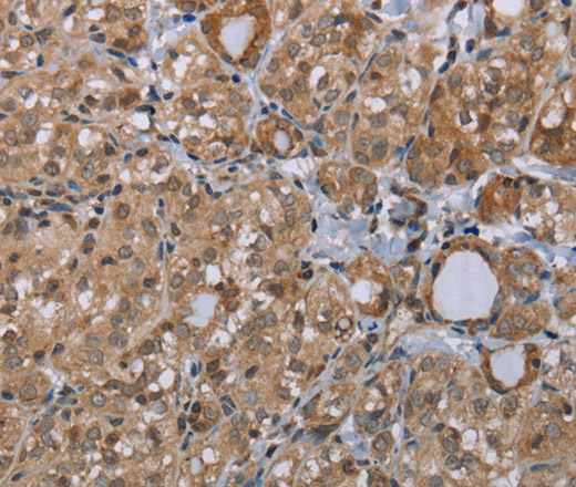 Immunohistochemistry of paraffin-embedded Human thyroid cancer tissue using LIMK1 Polyclonal Antibody at dilution 1:40