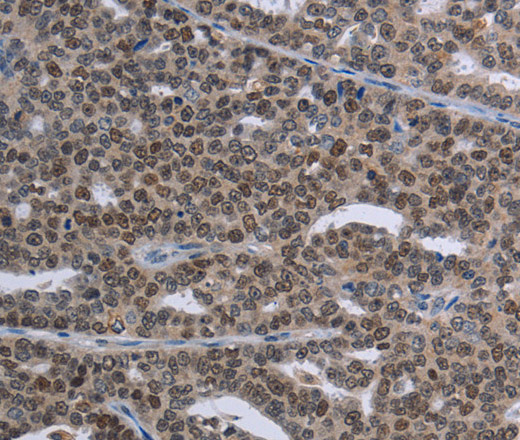 Immunohistochemistry of paraffin-embedded Human ovarian cancer tissue using MAGEC1 Polyclonal Antibody at dilution 1:30