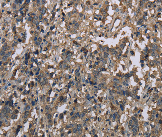 Immunohistochemistry of paraffin-embedded Human liver cancer tissue using MCC Polyclonal Antibody at dilution 1:30