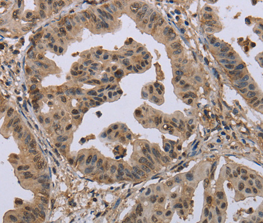 Immunohistochemistry of paraffin-embedded Human gastric cancer tissue using MCC Polyclonal Antibody at dilution 1:30