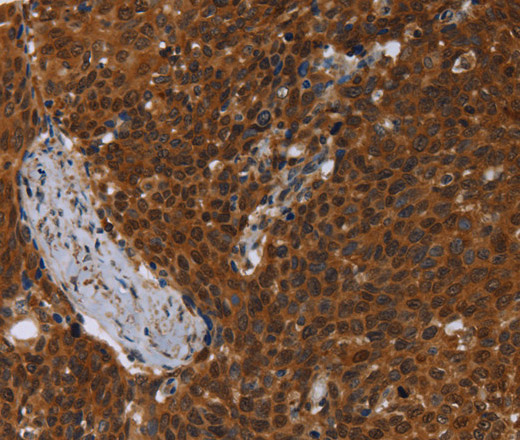 Immunohistochemistry of paraffin-embedded Human cervical cancer using MCHR1 Polyclonal Antibody at dilution of 1:30