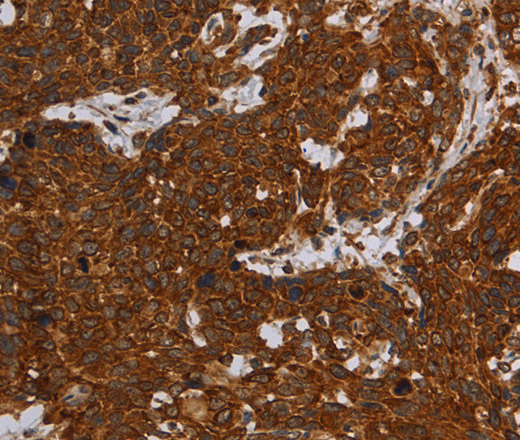 Immunohistochemistry of paraffin-embedded Human cervical cancer tissue using ERRFI1 Polyclonal Antibody at dilution 1:30