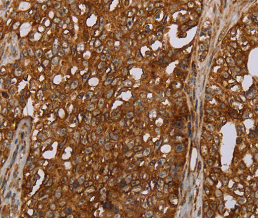 Immunohistochemistry of paraffin-embedded Human ovarian cancer tissue using ERRFI1 Polyclonal Antibody at dilution 1:30