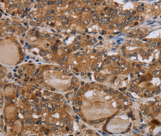 Immunohistochemistry of paraffin-embedded Human thyroid cancer using MT-ND1 Polyclonal Antibody at dilution of 1:50