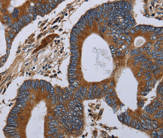 Immunohistochemistry of paraffin-embedded Human colon cancer tissue using MT-ND6 Polyclonal Antibody at dilution 1:40