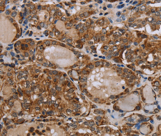 Immunohistochemistry of paraffin-embedded Human thyroid cancer tissue using MT-ND6 Polyclonal Antibody at dilution 1:40