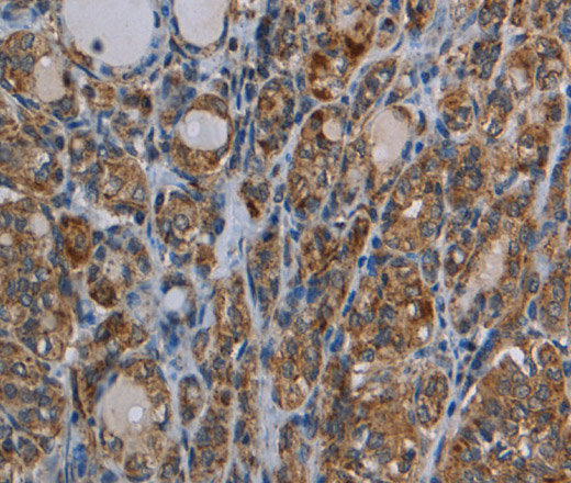 Immunohistochemistry of paraffin-embedded Human thyroid cancer tissue using MYO7A Polyclonal Antibody at dilution 1:30