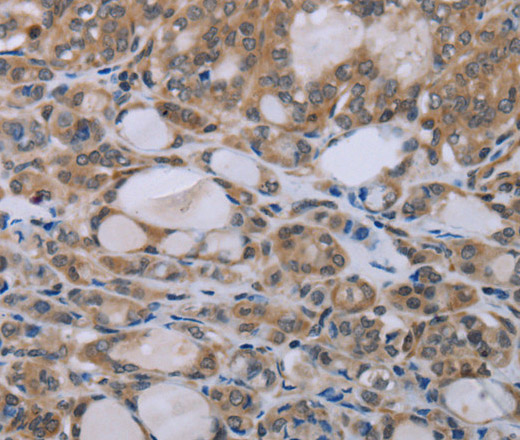 Immunohistochemistry of paraffin-embedded Human thyroid cancer tissue using NAIP Polyclonal Antibody at dilution 1:30