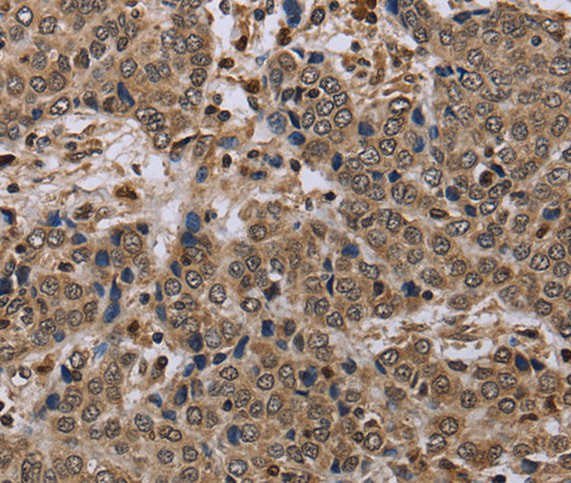 Immunohistochemistry of paraffin-embedded Human liver cancer tissue using NLRP4 Polyclonal Antibody at dilution 1:40