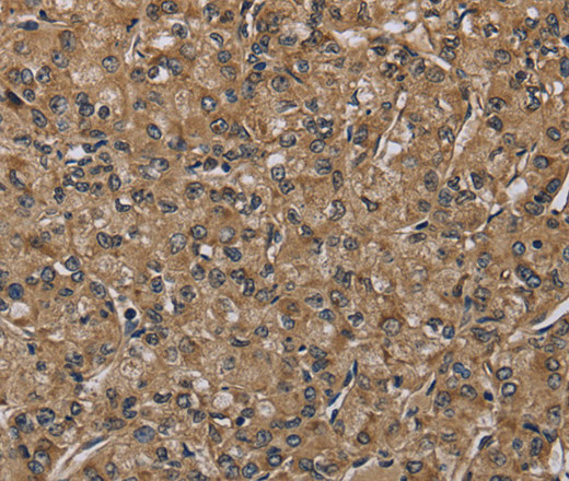 Immunohistochemistry of paraffin-embedded Human prostate cancer tissue using NLRP4 Polyclonal Antibody at dilution 1:40