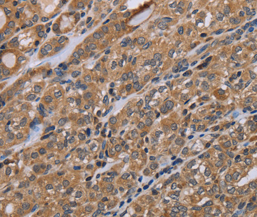 Immunohistochemistry of paraffin-embedded Human thyroid cancer tissue using NAA25 Polyclonal Antibody at dilution 1:40