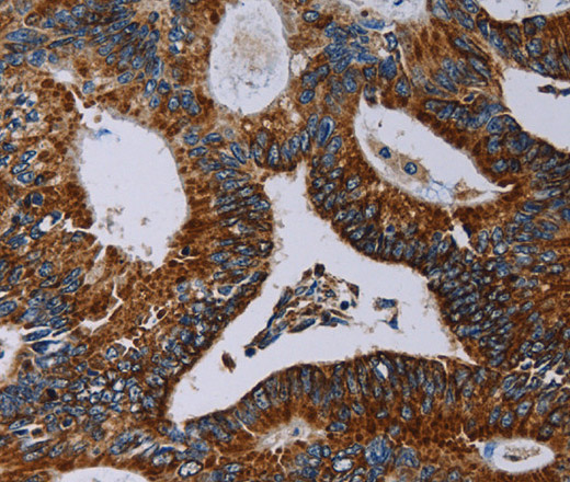 Immunohistochemistry of paraffin-embedded Human colon cancer using NDUFA4 Polyclonal Antibody at dilution of 1:40