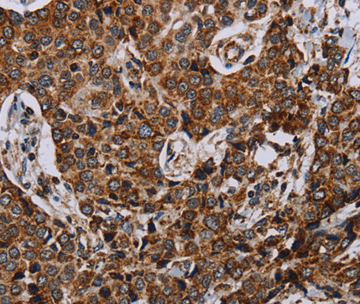 Immunohistochemistry of paraffin-embedded Human liver cancer using NDUFA4 Polyclonal Antibody at dilution of 1:40