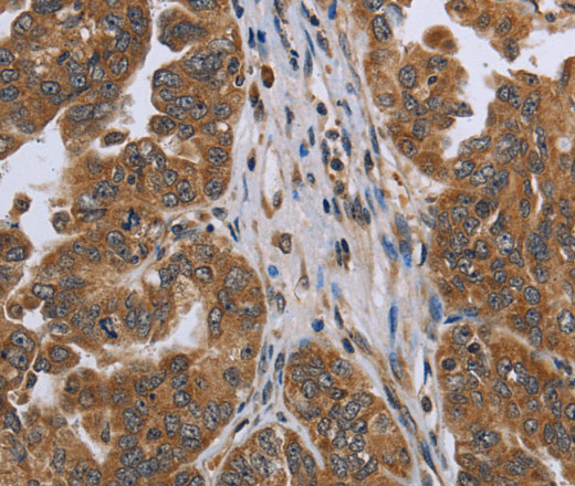 Immunohistochemistry of paraffin-embedded Human ovarian cancer using NDUFAF4 Polyclonal Antibody at dilution of 1:45