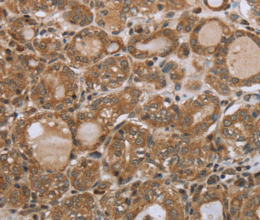 Immunohistochemistry of paraffin-embedded Human thyroid cancer using NDUFS2 Polyclonal Antibody at dilution of 1:35