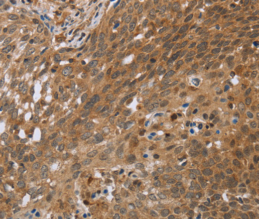 Immunohistochemistry of paraffin-embedded Human cervical cancer using NDUFS2 Polyclonal Antibody at dilution of 1:35