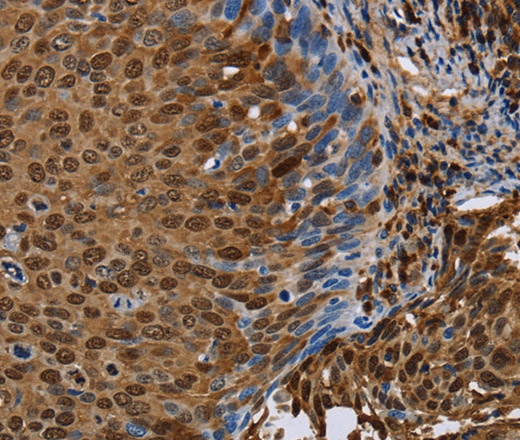 Immunohistochemistry of paraffin-embedded Human cervical cancer tissue using NRP2 Polyclonal Antibody at dilution 1:45