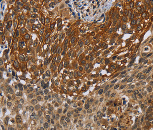 Immunohistochemistry of paraffin-embedded Human cervical cancer tissue using UHRF2 Polyclonal Antibody at dilution 1:40