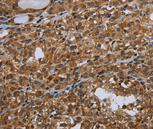 Immunohistochemistry of paraffin-embedded Human thyroid cancer tissue using UHRF2 Polyclonal Antibody at dilution 1:40