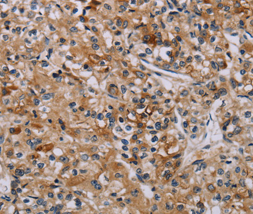 Immunohistochemistry of paraffin-embedded Human prostate cancer tissue using AATK Polyclonal Antibody at dilution 1:45