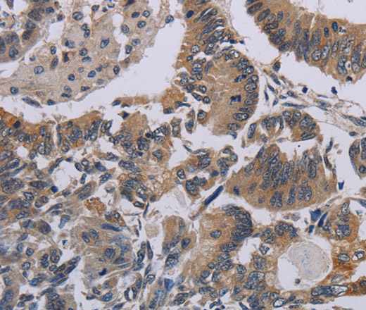 Immunohistochemistry of paraffin-embedded Human colon cancer tissue using CCL1 Polyclonal Antibody at dilution 1:50