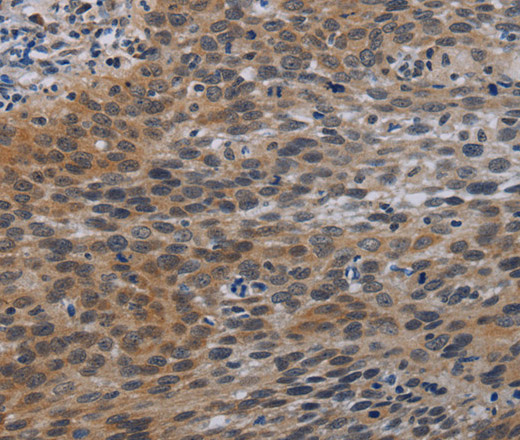 Immunohistochemistry of paraffin-embedded Human cervical cancer tissue using CCL1 Polyclonal Antibody at dilution 1:50