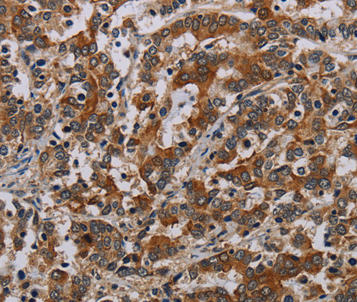 Immunohistochemistry of paraffin-embedded Human liver cancer tissue using NLRP9 Polyclonal Antibody at dilution 1:40