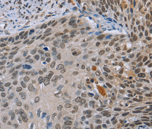 Immunohistochemistry of paraffin-embedded Human cervical cancer tissue using NMT1 Polyclonal Antibody at dilution 1:45