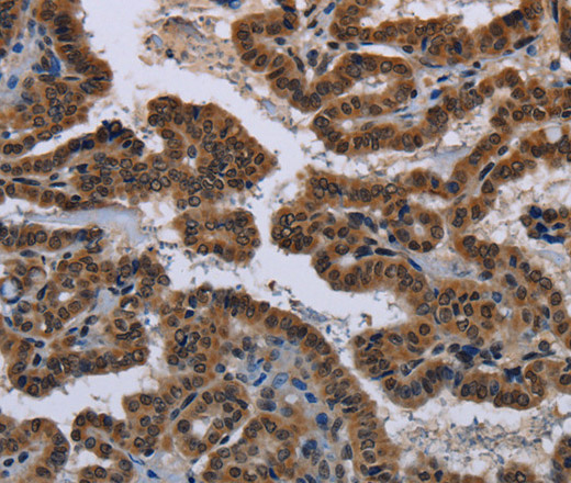 Immunohistochemistry of paraffin-embedded Human gastric cancer tissue using MYCN Polyclonal Antibody at dilution 1:35